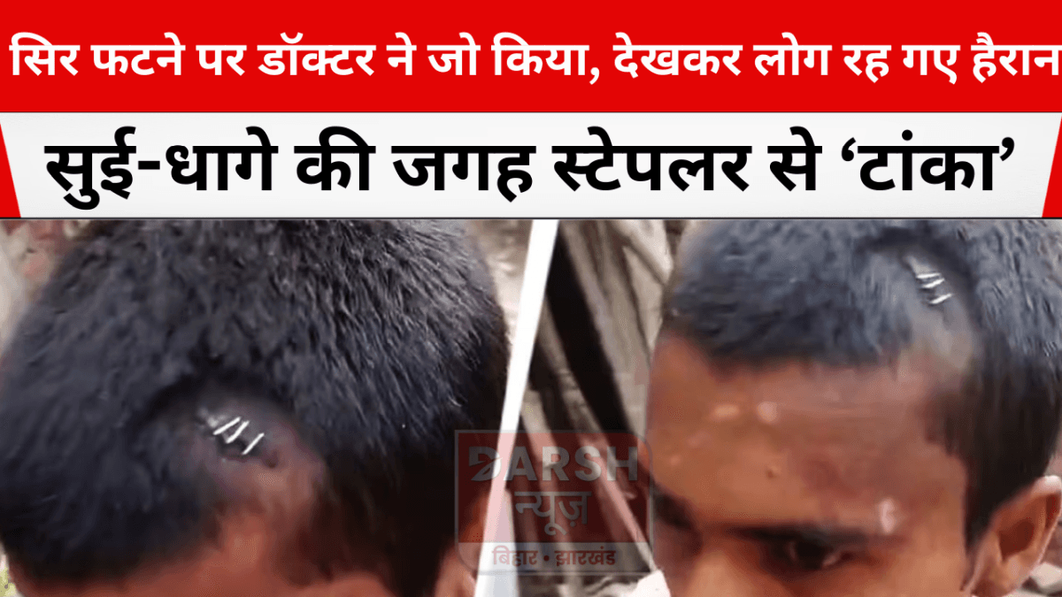 सिर फटने पर डॉक्टर ने जो किया, देखकर लोग रह गए हैरान… सुई-धागे की जगह स्टेपलर से ‘टांका’